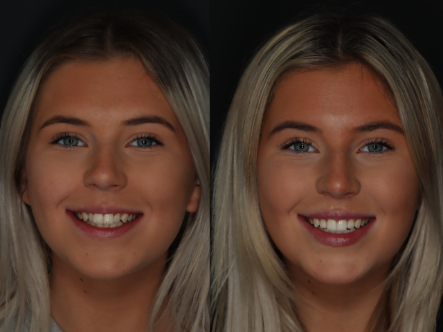 Photo of Anabel before and after