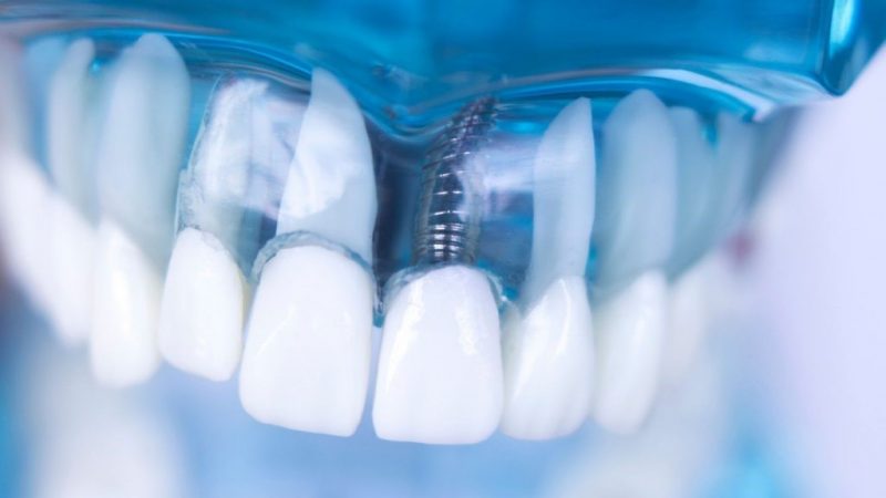 Can-You-Have-Dental-Implants-If-You-Have-Gum-Disease