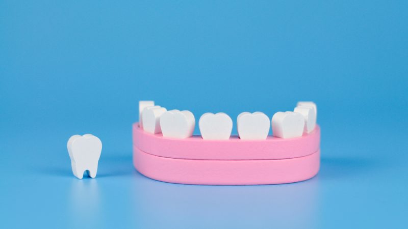 Dental Implants Questions Answered