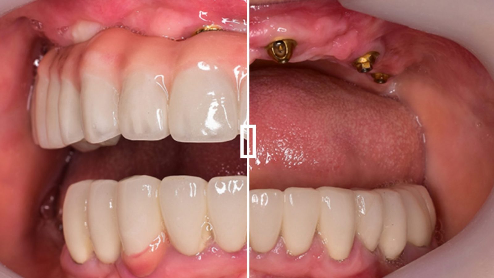 Implant retained denture