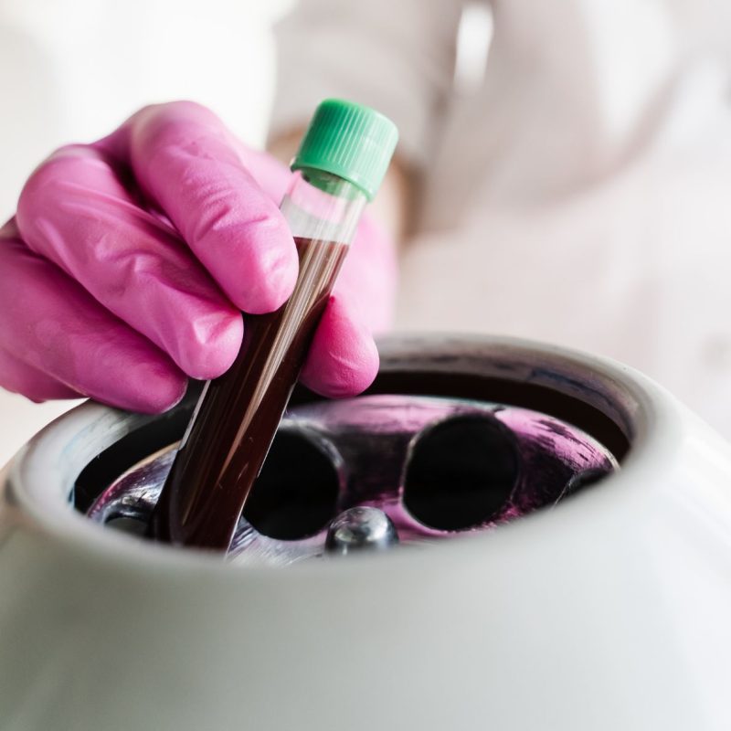 PRGF for implants in Bournemouth