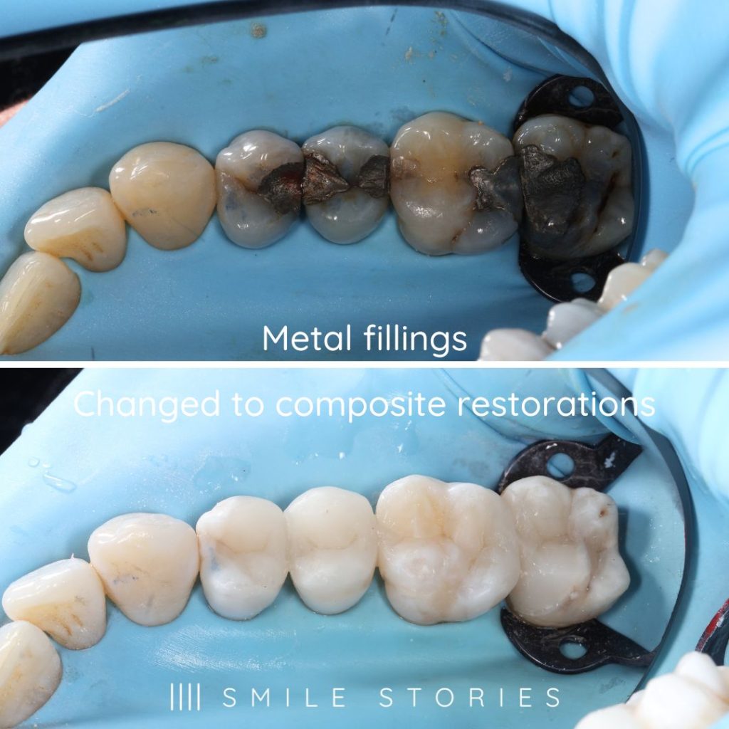 can private dentists do fillings
