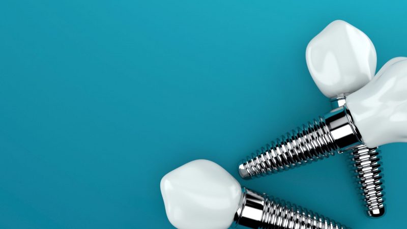 dental implants NHS