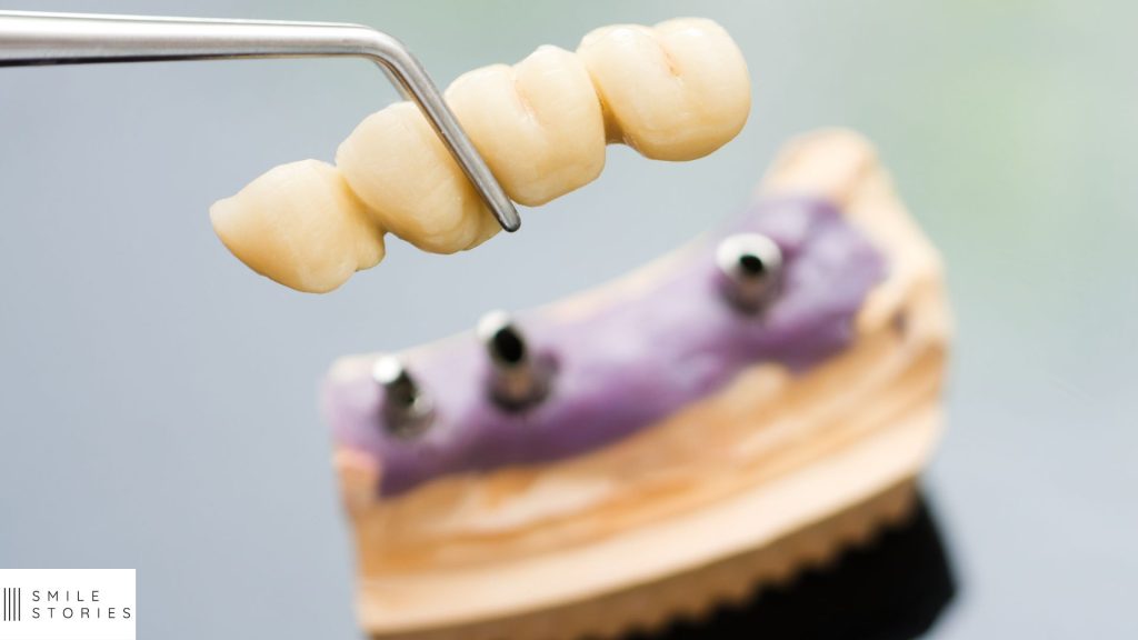 close up of an implant supported bridge and mock lower jaw