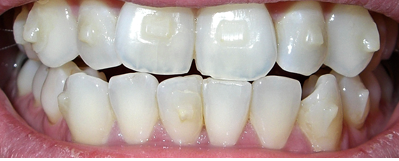 How They Remove Invisalign Attachments Or Buttons… – My Invisalign Blog