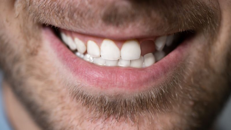 close up of a male mouth with the lateral incisor missing