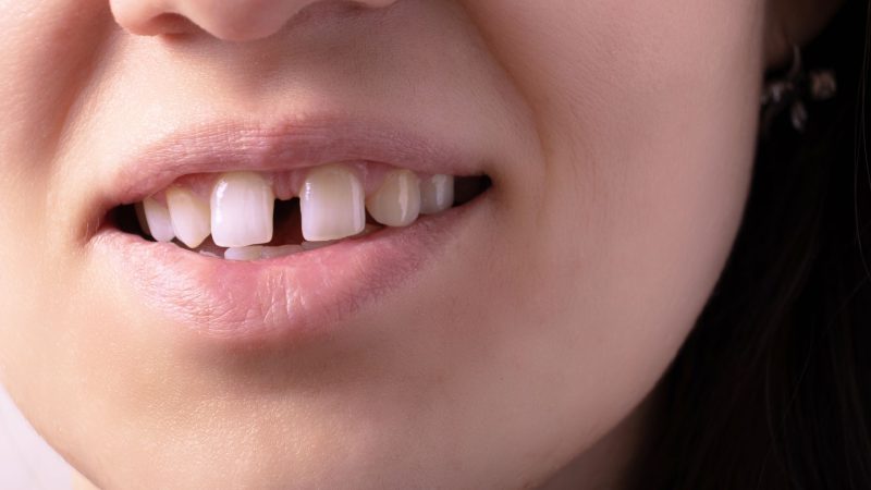 close up of female mouth - there's a gap between her teeth
