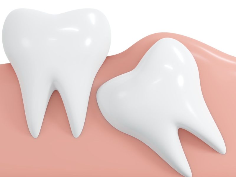 wisdom tooth removal in Bournemouth