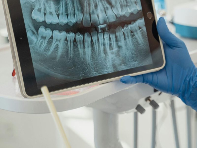opg x-ray for dental implants